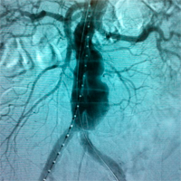 Clases Aneurisma de aorta abdominal