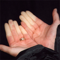 Clases Fenómeno de Raynaud