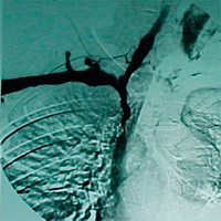 Clases Síndrome vena cava superior