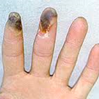 Clases Enfermedad de Buerger