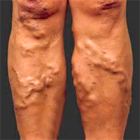 Clases Varices úlceras vasculares