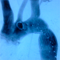 Clases Coartación de aorta