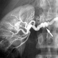 Clases Hipertensión vásculo-renal