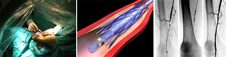 Tratamiento endovascular de una lesión esteno-oclusiva de femoral superficial (TASC-A)