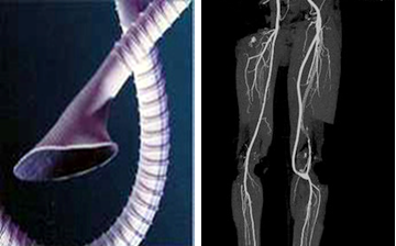 Bypass con prótesis de PTFE en la extremidad inferior izquierda