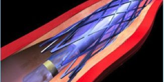 ENDOVASCULAR1