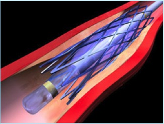 ENDOVASCULAR1